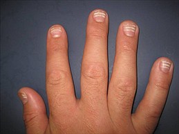 nail disorders